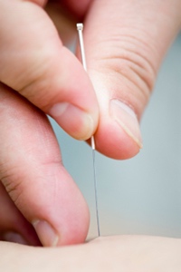 Dry Needling | Medford MA